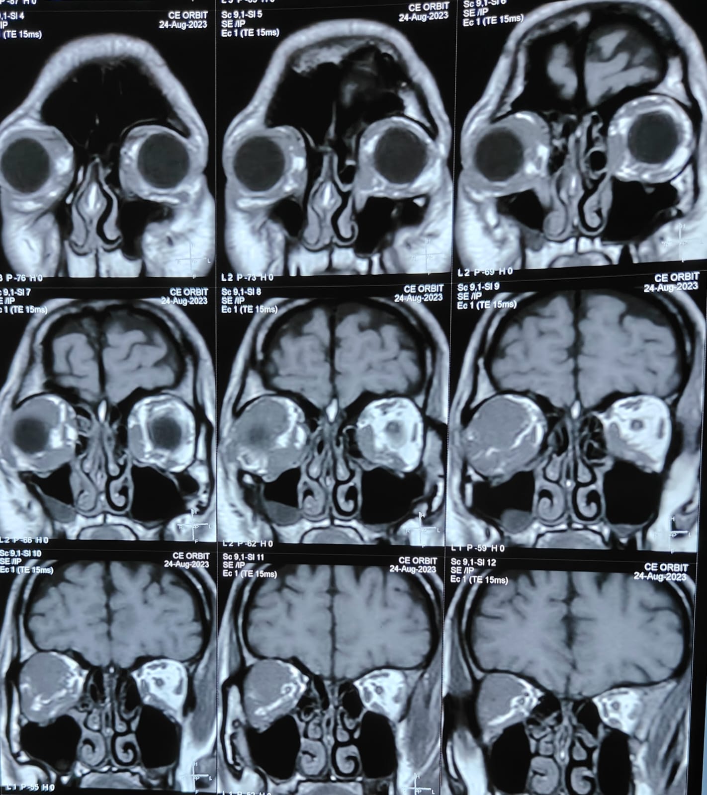 CT scan showing blow out fracture